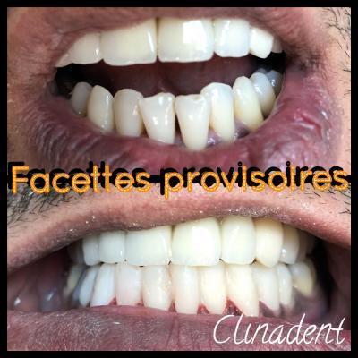 Facettes dentaires au Centre Clinadent à Paris 15
