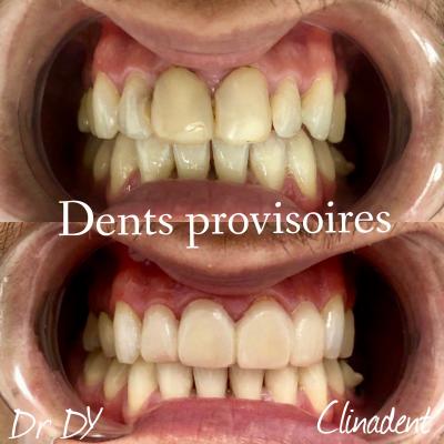 couronnes provisoires dentiste paris 15
