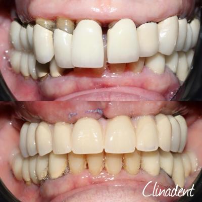 Technique implants dentaire clinadent paris 15